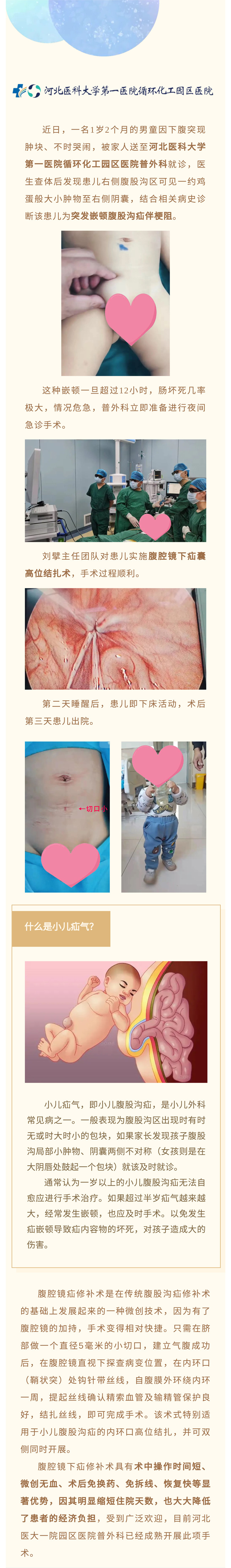 腹腔鏡微創(chuàng)手術(shù)治療小兒疝氣——切口5毫米！手術(shù)→活動，僅半天！-1.jpg